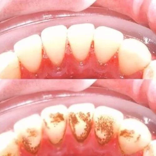 Mislite na vreme, ne čekajte da Vas zabole desni, ne čekajte da odlazak zubaru bude mučan i skup, mislite o svojim zubima i na vreme koristite ovaj fenomenalni ultrazvučni čistač kamenca.